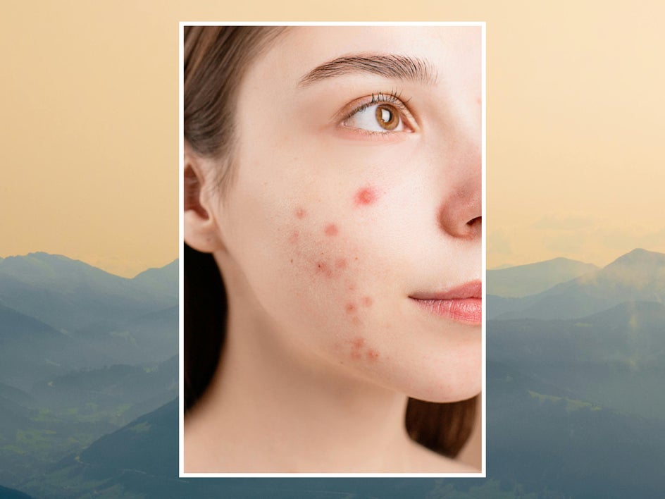 Before: Close-up selfie with noticeable facial blemishes. After: Same selfie with blemishes removed, skin texture preserved naturally.